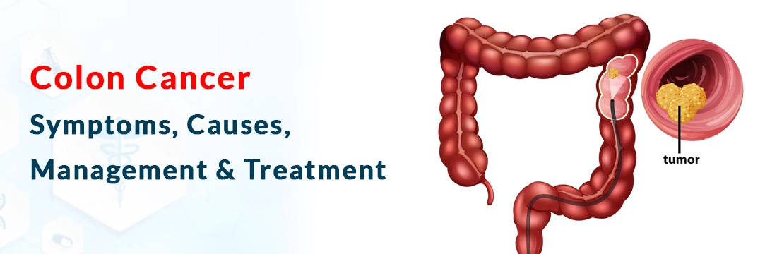 Colon Cancer: Symptoms, Causes, Management & Treatment